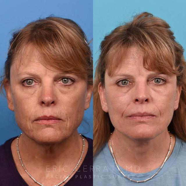 Laser Skin Resurfacing result at Eric W. Cerrati, MD, FACS in Salt Lake City, UT
