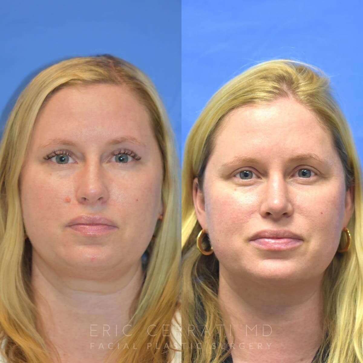Eric W. Cerrati, MD, FACS rhinoplasty result — Salt Lake City, UT