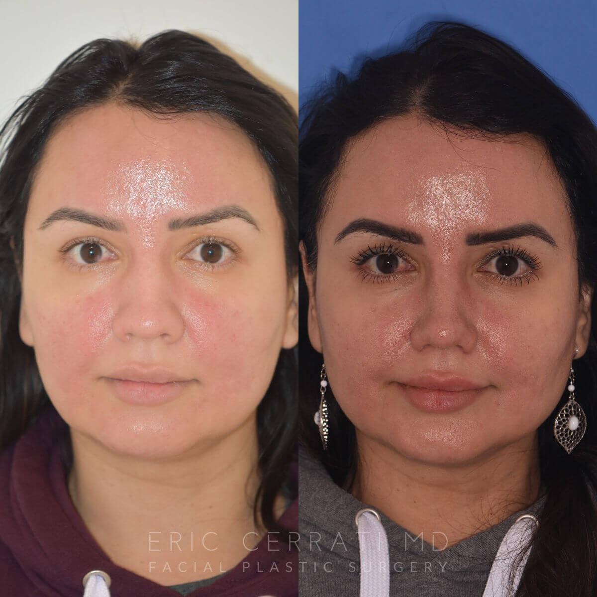 Eric W. Cerrati, MD, FACS buccal fat removal result — Salt Lake City, UT