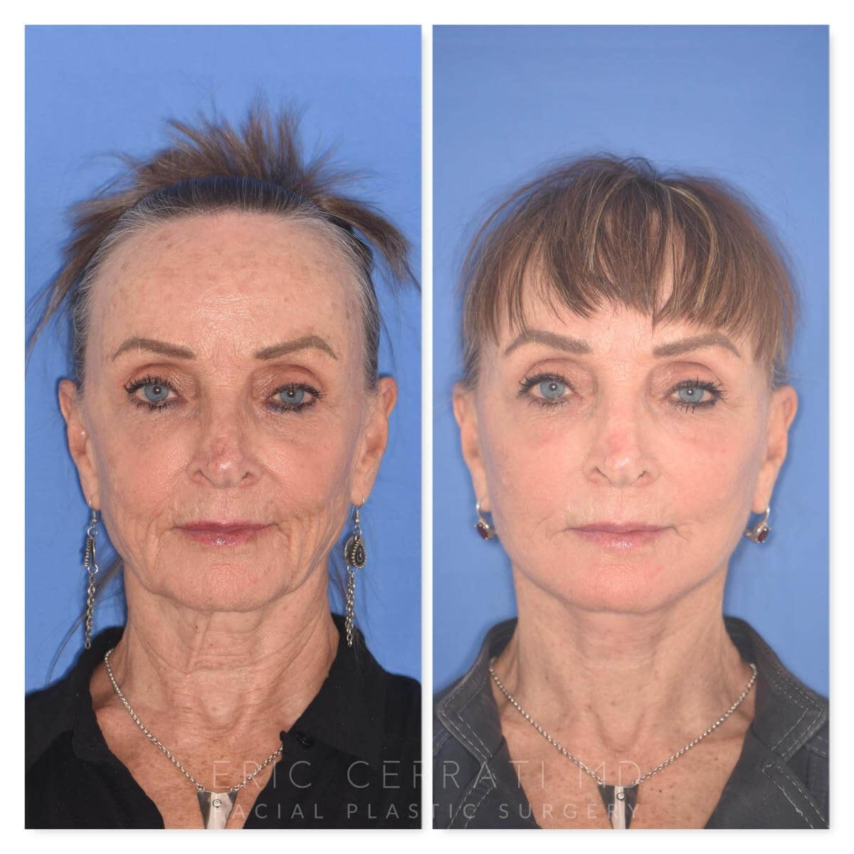 Eric W. Cerrati, MD, FACS buccal fat removal result — Salt Lake City, UT