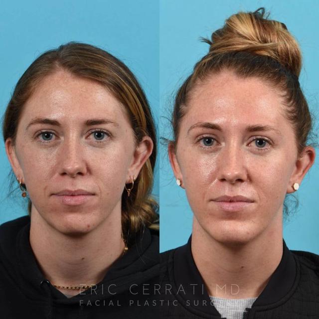 Chin Implant result at Eric W. Cerrati, MD, FACS in Salt Lake City, UT