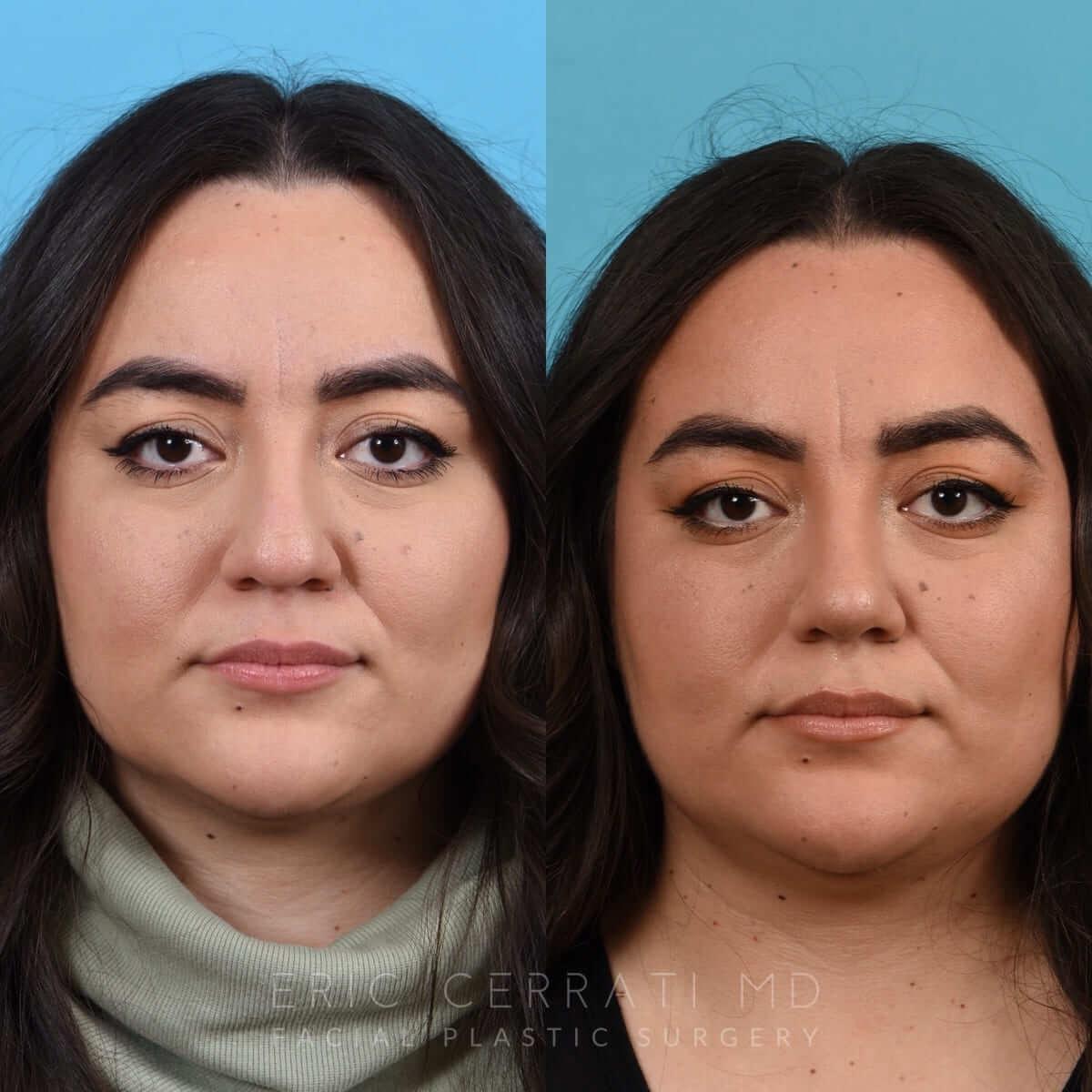 Eric W. Cerrati, MD, FACS rhinoplasty result — Salt Lake City, UT
