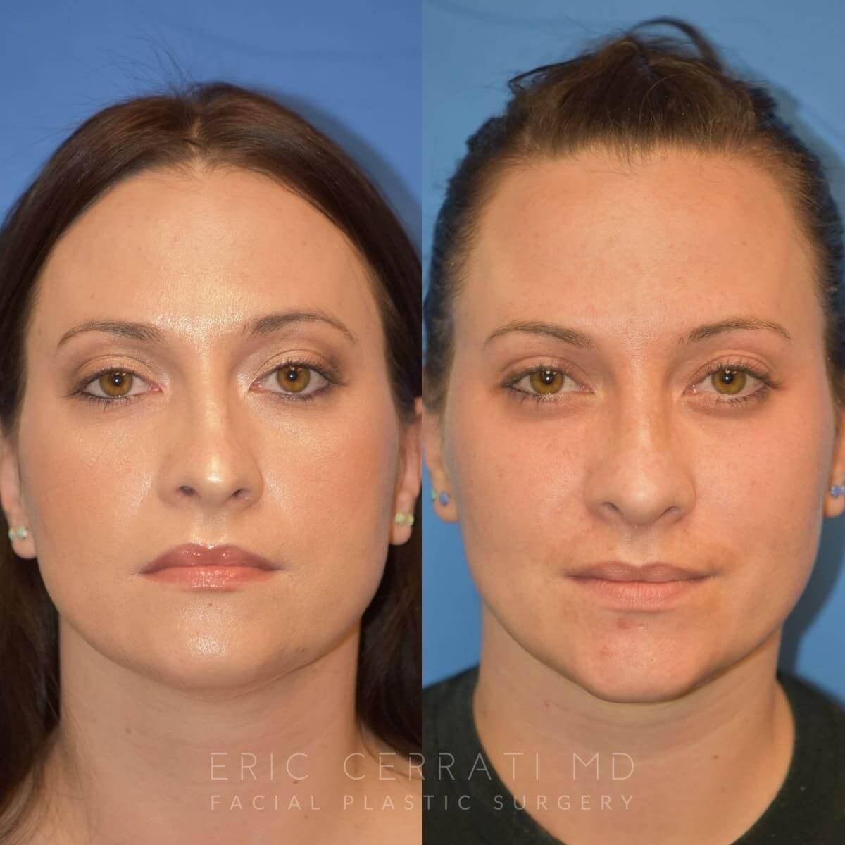 Eric W. Cerrati, MD, FACS rhinoplasty result — Salt Lake City, UT