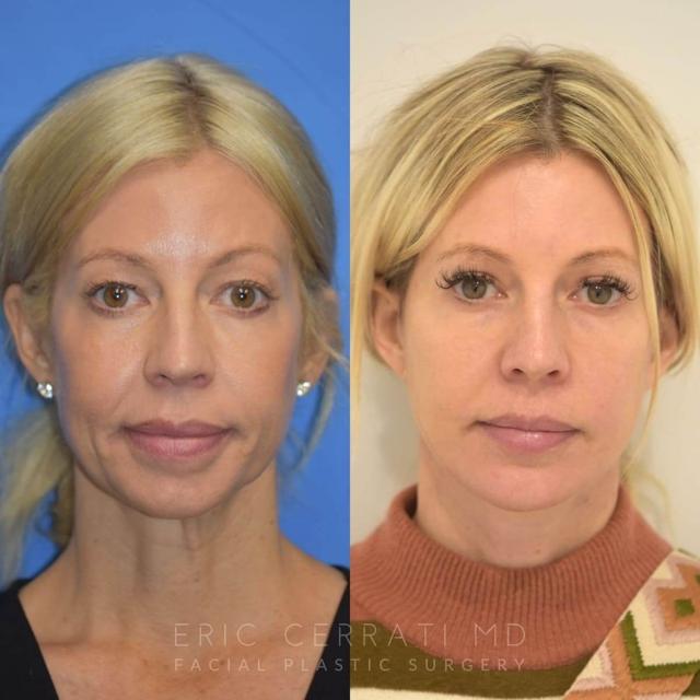 Chin Implant result at Eric W. Cerrati, MD, FACS in Salt Lake City, UT