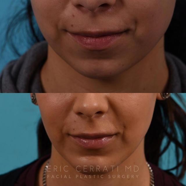 Chin Implant result at Eric W. Cerrati, MD, FACS in Salt Lake City, UT