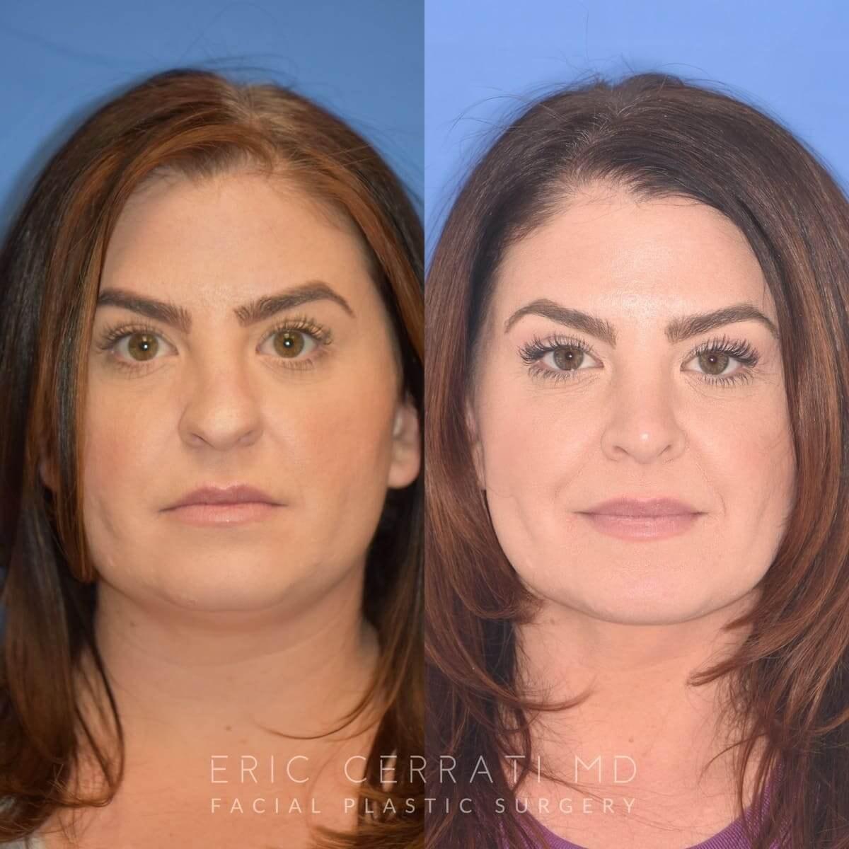 Eric W. Cerrati, MD, FACS rhinoplasty result — Salt Lake City, UT