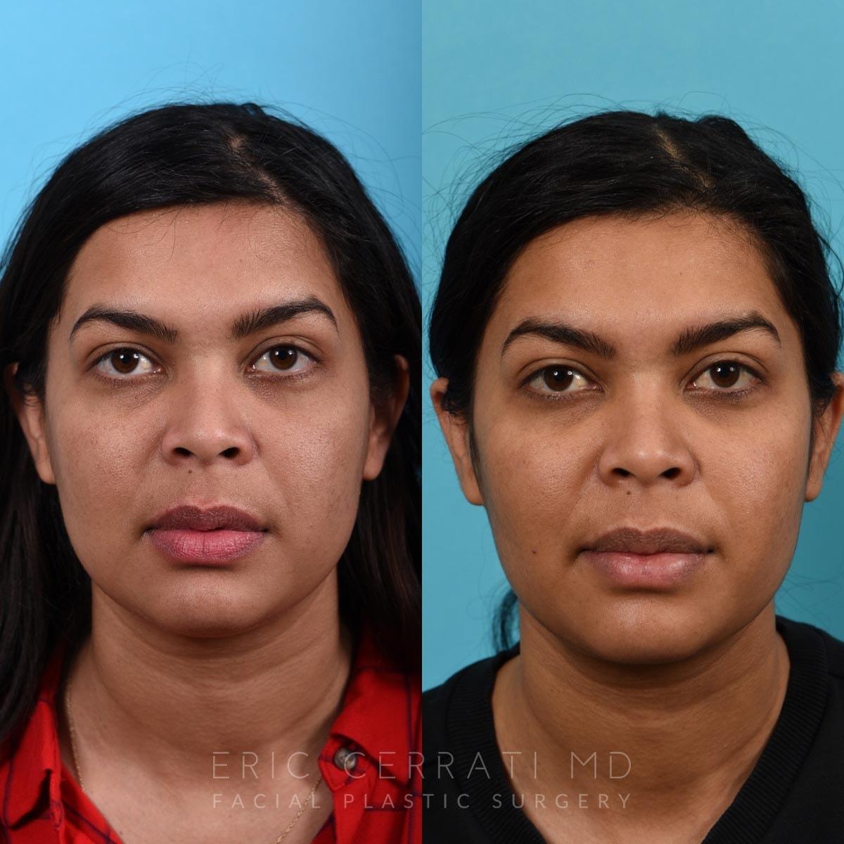 Eric W. Cerrati, MD, FACS buccal fat removal result — Salt Lake City, UT
