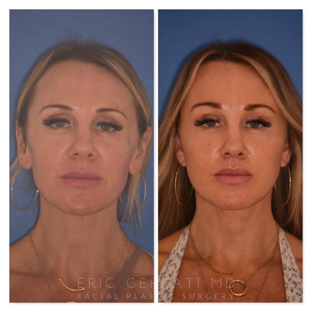 Brow Lift result at Eric W. Cerrati, MD, FACS in Salt Lake City, UT