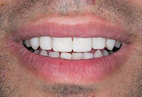 Santa Clara Dental veneers after — Santa Clara, UT