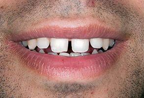 Dental Veneers before at Santa Clara Dental in Santa Clara, UT