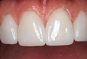 Santa Clara Dental veneers after — Santa Clara, UT