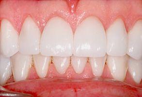 Dental Veneers after at Santa Clara Dental in Santa Clara, UT
