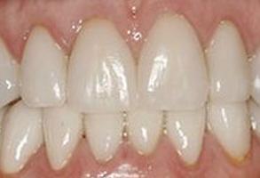 Dental Veneers after at Santa Clara Dental in Santa Clara, UT