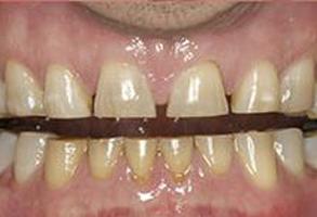 Dental Veneers before at Santa Clara Dental in Santa Clara, UT