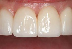 Santa Clara Dental veneers after — Santa Clara, UT