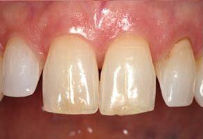 Dental Veneers before at Santa Clara Dental in Santa Clara, UT