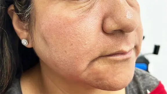 South Bay Med Spa skin tightening result — Torrance, CA