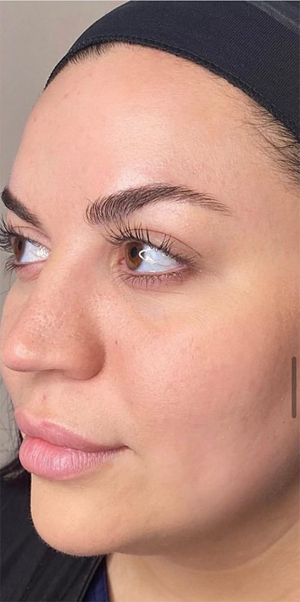 South Bay Med Spa chemical peel after — Torrance, CA