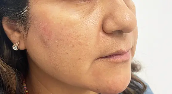 South Bay Med Spa skin tightening result — Torrance, CA