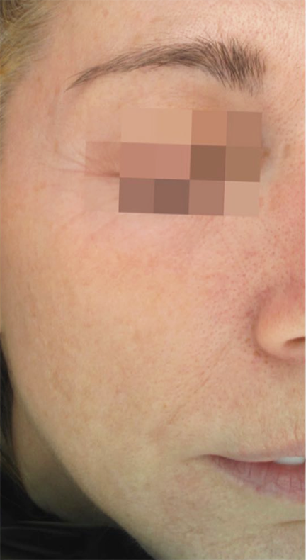 South Bay Med Spa chemical peel after — Torrance, CA