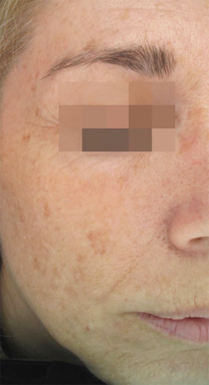 Chemical Peel before at South Bay Med Spa in Torrance, CA