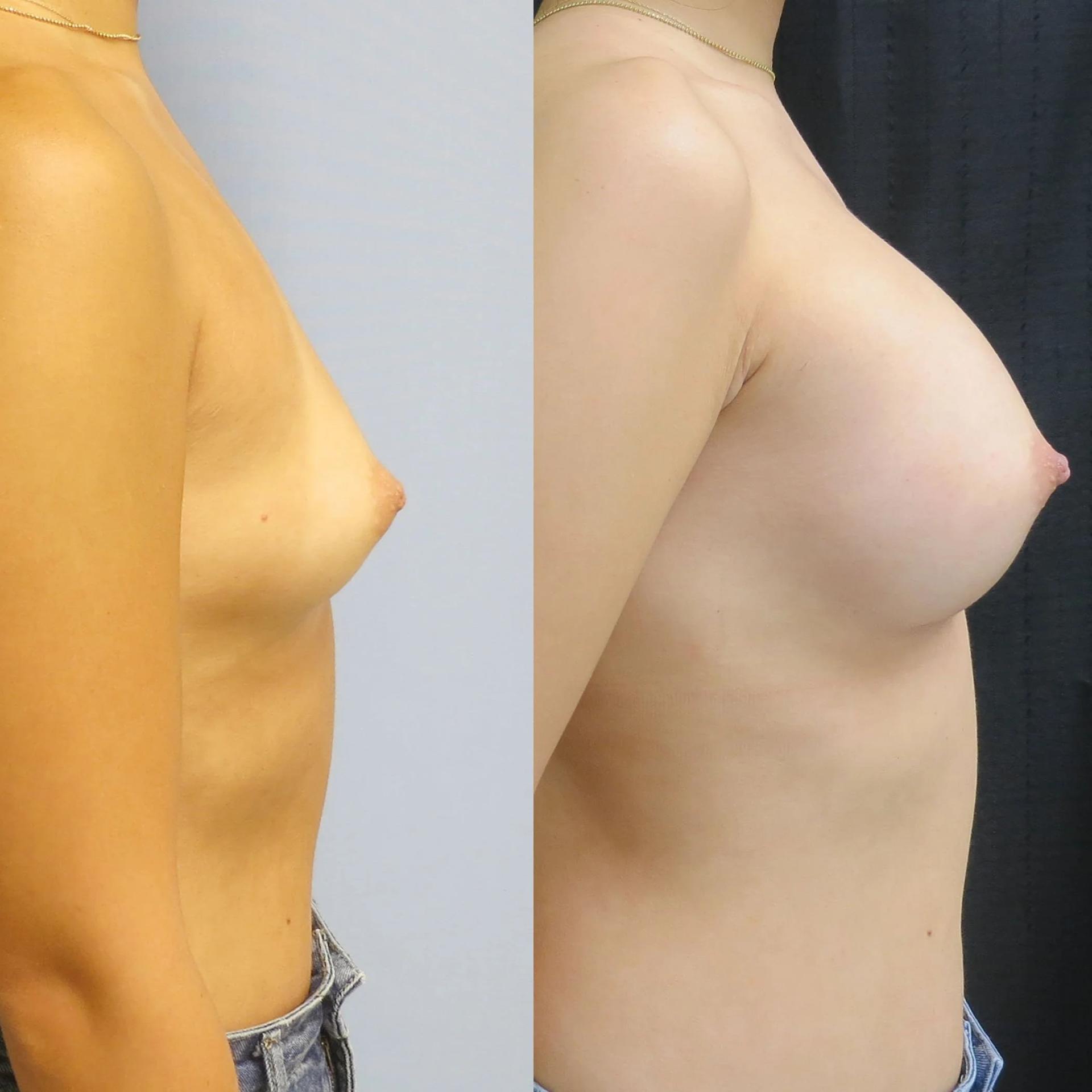 Justin R Fernandes, MD breast augmentation result โ Danvers, MA