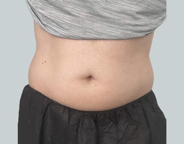 Thigh Lift before at Studio Esthetique Skin & Laser Center NYC in New York, NY