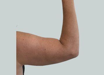 Studio Esthetique Skin & Laser Center NYC coolsculpting after — New York, NY