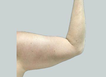 CoolSculpting before at Studio Esthetique Skin & Laser Center NYC in New York, NY