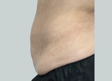 Studio Esthetique Skin & Laser Center NYC coolsculpting after — New York, NY