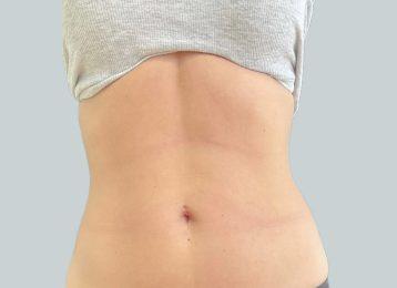 Studio Esthetique Skin & Laser Center NYC coolsculpting after — New York, NY