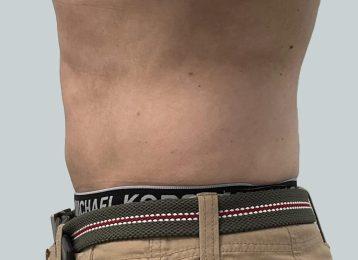 Studio Esthetique Skin & Laser Center NYC coolsculpting after — New York, NY