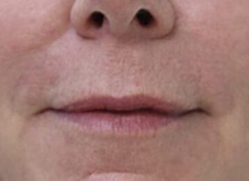 Studio Esthetique Skin & Laser Center NYC breast augmentation after — New York, NY