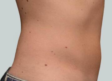 Studio Esthetique Skin & Laser Center NYC coolsculpting after — New York, NY