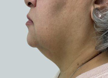 Studio Esthetique Skin & Laser Center NYC coolsculpting after — New York, NY