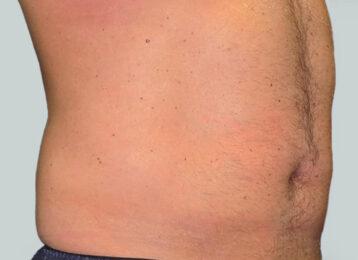Studio Esthetique Skin & Laser Center NYC coolsculpting after — New York, NY