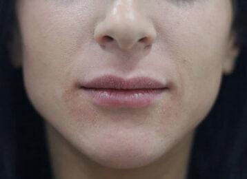 Studio Esthetique Skin & Laser Center NYC breast augmentation after — New York, NY