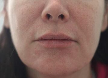 Studio Esthetique Skin & Laser Center NYC breast augmentation after — New York, NY