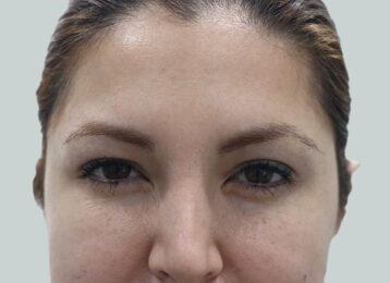 Studio Esthetique Skin & Laser Center NYC botox after — New York, NY