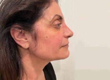 Studio Esthetique Skin & Laser Center NYC rhinoplasty after — New York, NY