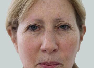 Botox before at Studio Esthetique Skin & Laser Center NYC in New York, NY