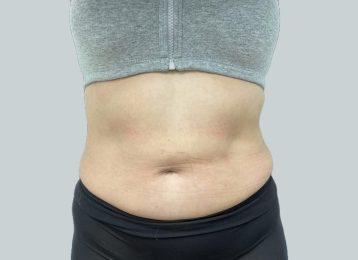 CoolSculpting after at Studio Esthetique Skin & Laser Center NYC in New York, NY