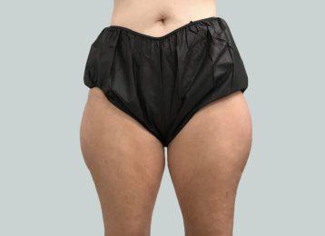 CoolSculpting after at Studio Esthetique Skin & Laser Center NYC in New York, NY