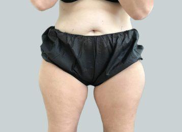 CoolSculpting before at Studio Esthetique Skin & Laser Center NYC in New York, NY