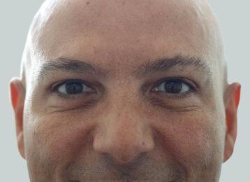 Studio Esthetique Skin & Laser Center NYC botox after — New York, NY