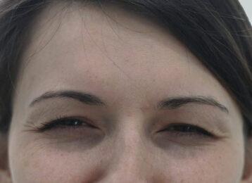 Studio Esthetique Skin & Laser Center NYC botox after — New York, NY