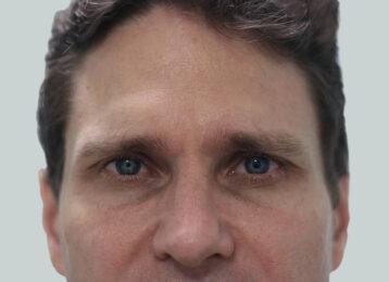 Studio Esthetique Skin & Laser Center NYC botox after — New York, NY
