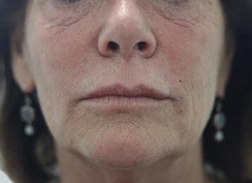 Studio Esthetique Skin & Laser Center NYC breast augmentation after — New York, NY