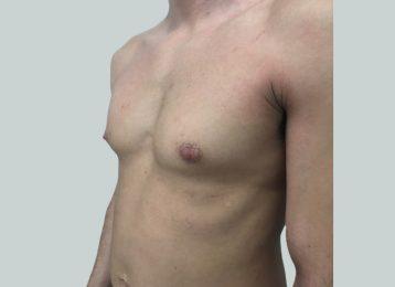 Studio Esthetique Skin & Laser Center NYC coolsculpting after — New York, NY