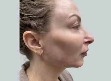 Studio Esthetique Skin & Laser Center NYC rhinoplasty after — New York, NY